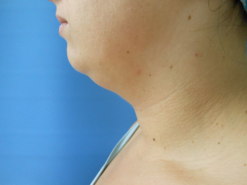 Neck Before & After Gallery - Patient 51821629 - Image 1
