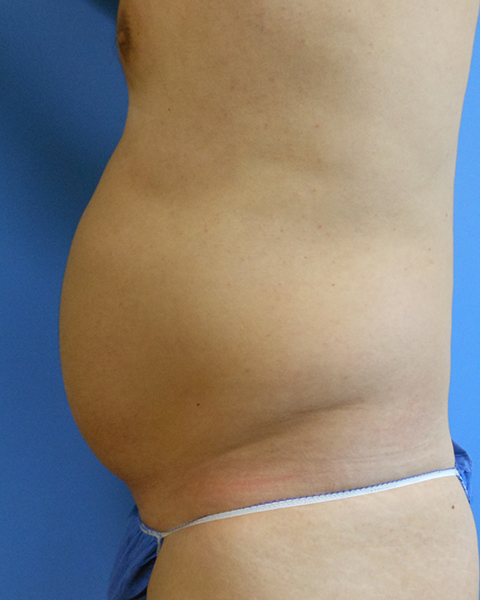 Abdomen Before & After Gallery - Patient 51821632 - Image 3