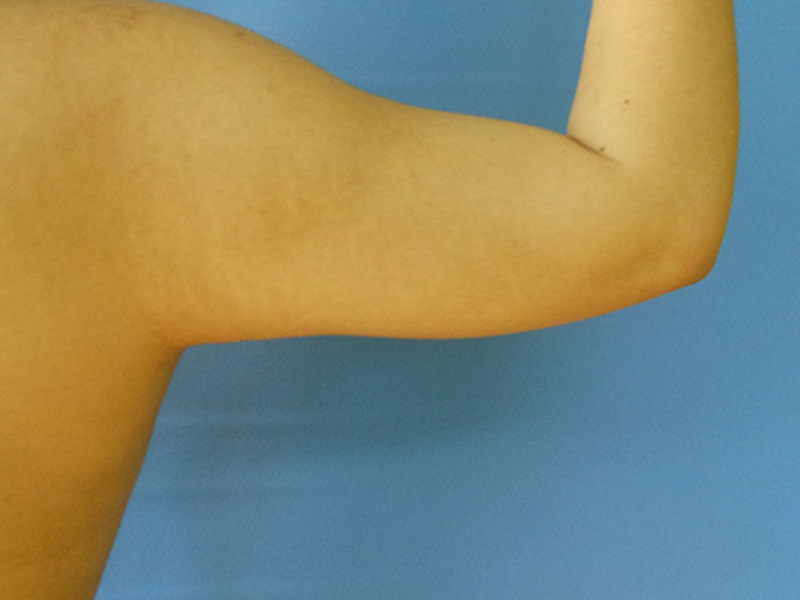 Arms Before & After Gallery - Patient 51821634 - Image 1