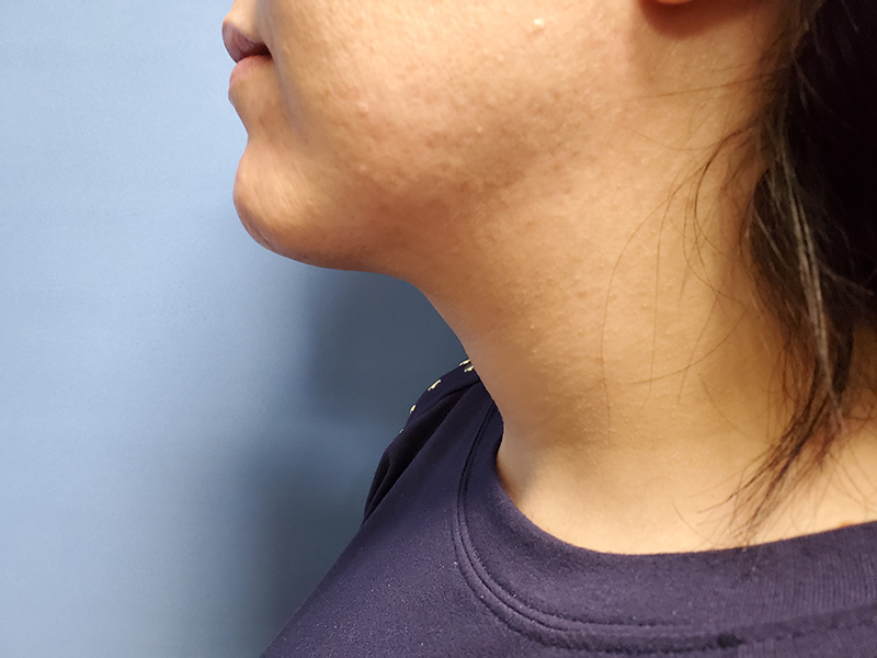 Neck Before & After Gallery - Patient 51821636 - Image 2