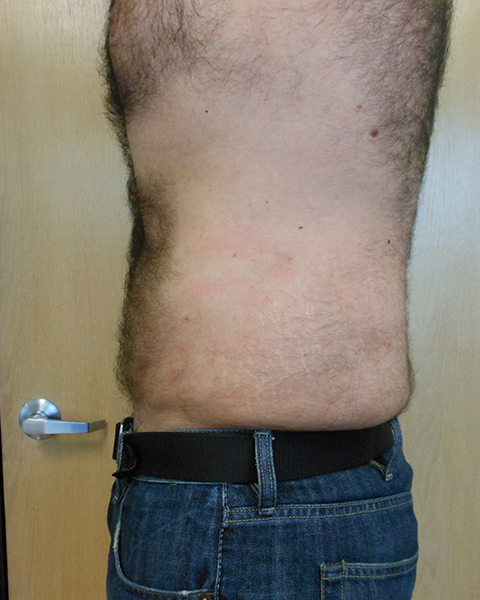 Abdomen Before & After Gallery - Patient 51821635 - Image 4