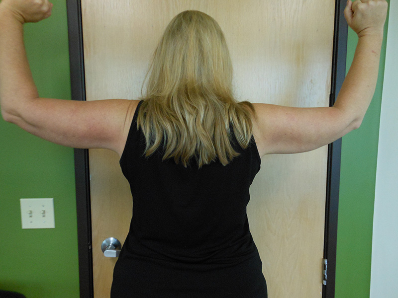 Arms Before & After Gallery - Patient 51821638 - Image 2