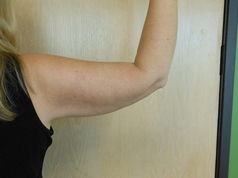 Arms Before & After Gallery - Patient 51821638 - Image 3