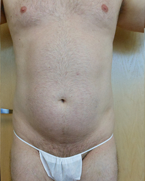 Abdomen Before & After Gallery - Patient 51821639 - Image 1