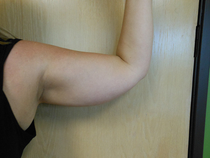 Arms Before & After Gallery - Patient 51821638 - Image 4