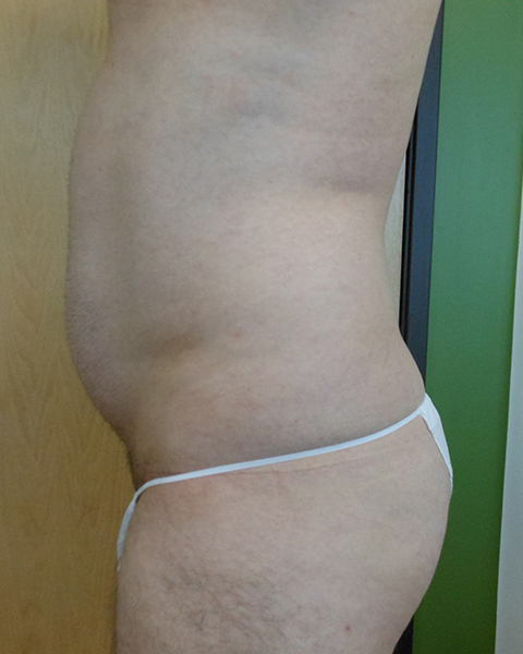 Abdomen Before & After Gallery - Patient 51821639 - Image 3