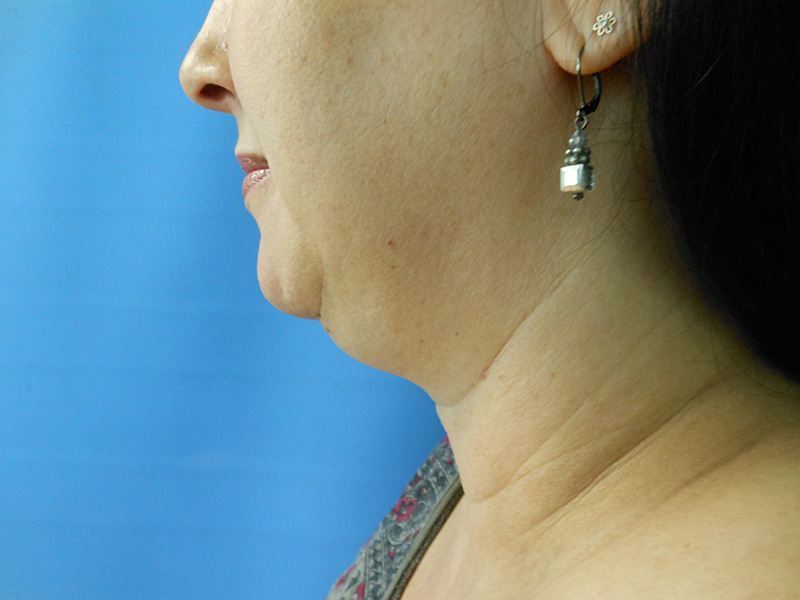 Neck Before & After Gallery - Patient 51821643 - Image 1