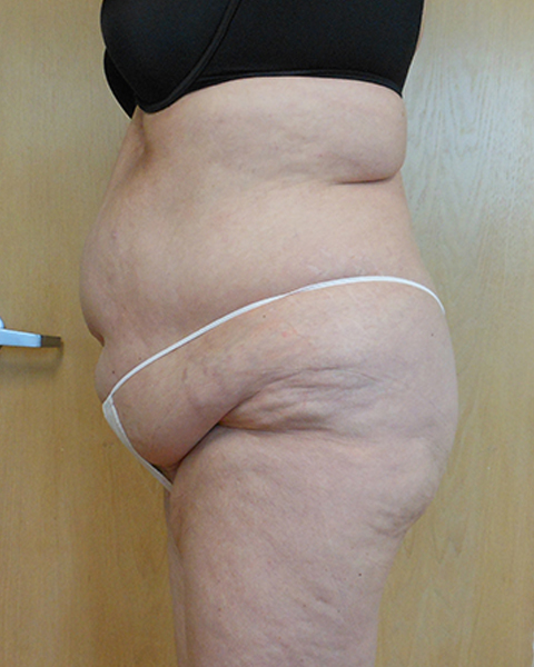 Abdomen Before & After Gallery - Patient 51821646 - Image 1
