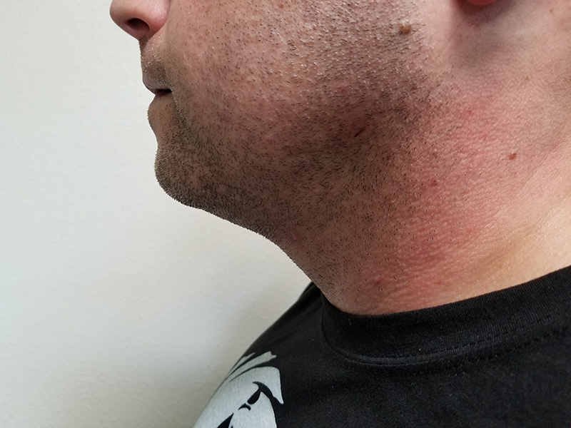 Neck Before & After Gallery - Patient 51821645 - Image 2