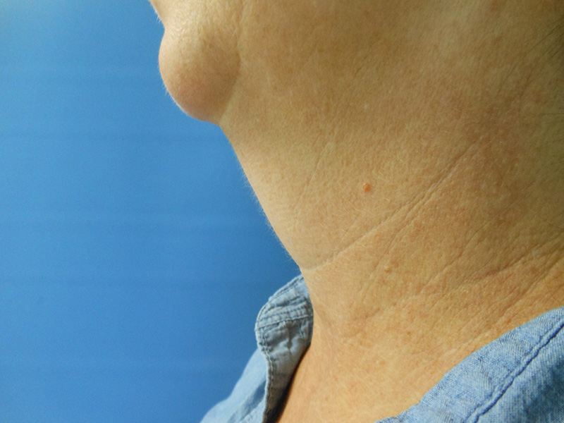 Neck Before & After Gallery - Patient 51821647 - Image 1