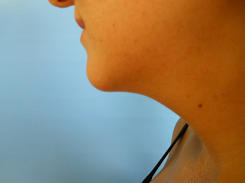 Neck Before & After Gallery - Patient 51821649 - Image 1