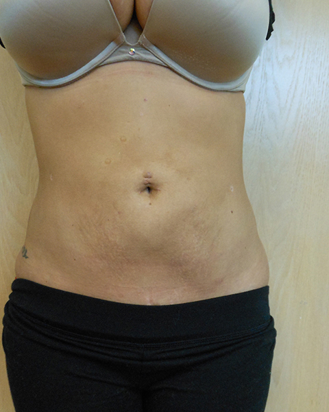 Abdomen Before & After Gallery - Patient 51821650 - Image 2