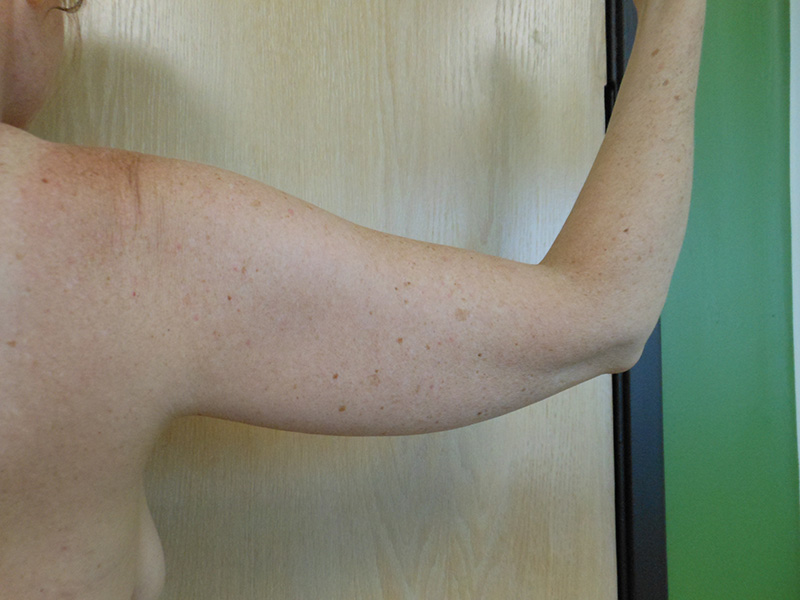 Arms Before & After Gallery - Patient 51821651 - Image 1