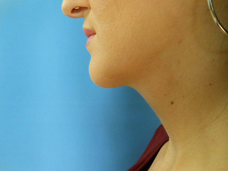 Neck Before & After Gallery - Patient 51821649 - Image 2