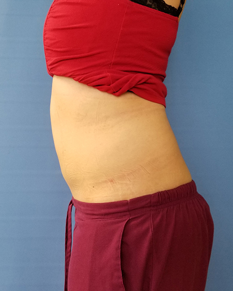 Abdomen Before & After Gallery - Patient 51821652 - Image 2