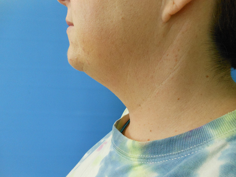 Neck Before & After Gallery - Patient 51821656 - Image 2