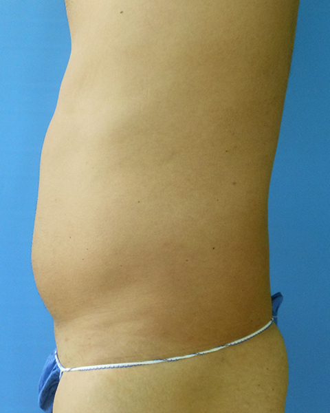 Abdomen Before & After Gallery - Patient 51821657 - Image 1