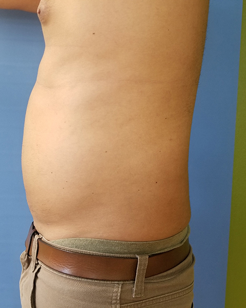 Abdomen Before & After Gallery - Patient 51821657 - Image 2