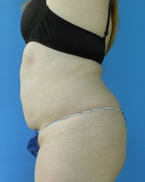 Abdomen Before & After Gallery - Patient 51821659 - Image 1