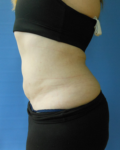 Abdomen Before & After Gallery - Patient 51821659 - Image 2