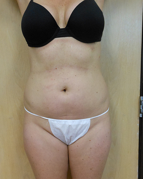 Abdomen Before & After Gallery - Patient 51821661 - Image 1
