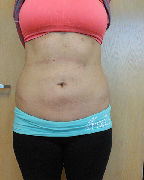 Abdomen Before & After Gallery - Patient 51821661 - Image 2