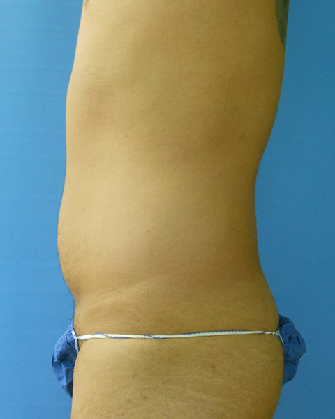 Abdomen Before & After Gallery - Patient 51821663 - Image 3