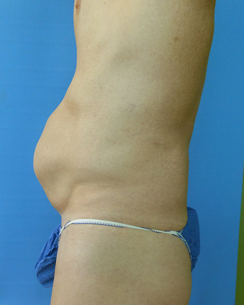 Abdomen Before & After Gallery - Patient 51821664 - Image 3