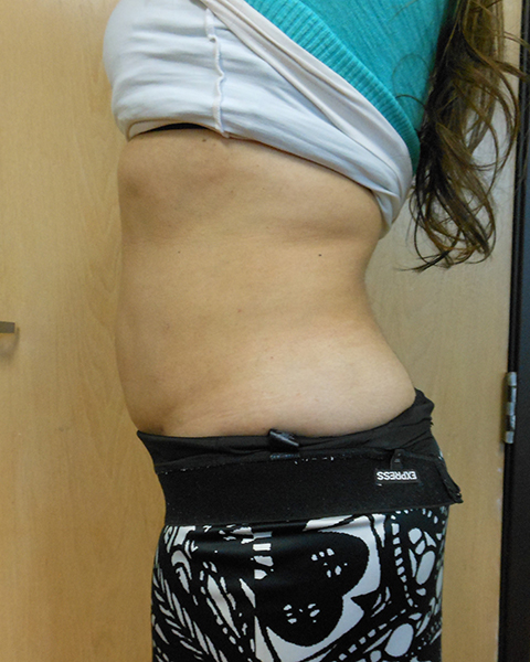 Abdomen Before & After Gallery - Patient 51821666 - Image 4