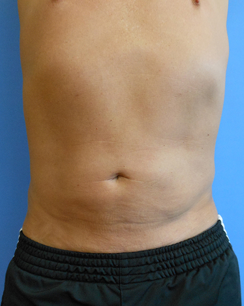 Abdomen Before & After Gallery - Patient 51821667 - Image 2