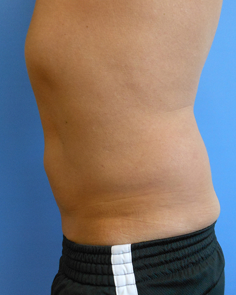 Abdomen Before & After Gallery - Patient 51821667 - Image 4