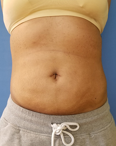 Abdomen Before & After Gallery - Patient 51821669 - Image 2