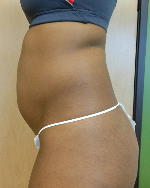 Abdomen Before & After Gallery - Patient 51821671 - Image 3
