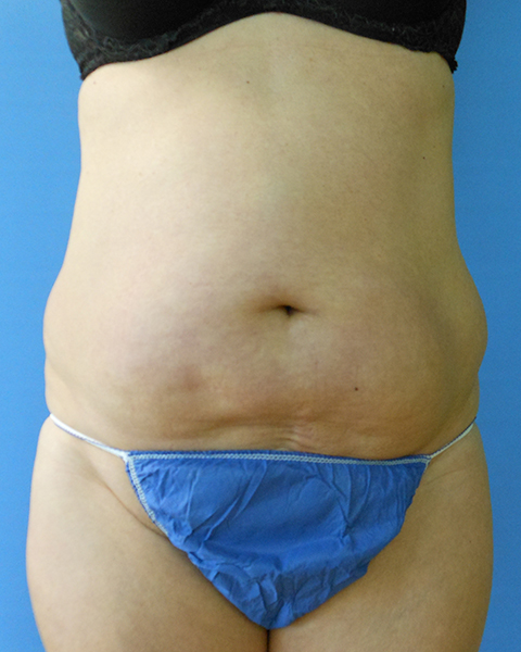 Abdomen Before & After Gallery - Patient 51821672 - Image 1