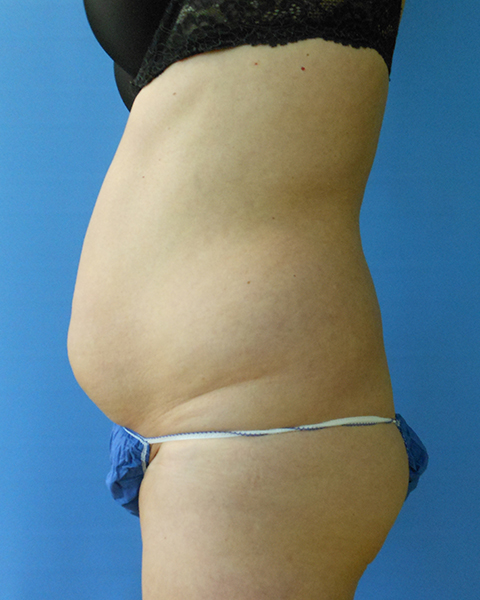 Abdomen Before & After Gallery - Patient 51821672 - Image 3