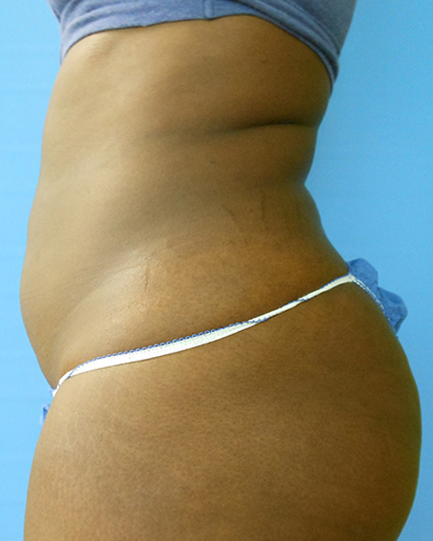 Abdomen Before & After Gallery - Patient 51821674 - Image 3