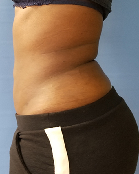 Abdomen Before & After Gallery - Patient 51821674 - Image 4