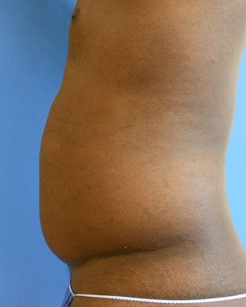 Abdomen Before & After Gallery - Patient 51821679 - Image 3