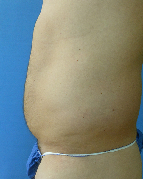 Abdomen Before & After Gallery - Patient 51821681 - Image 1