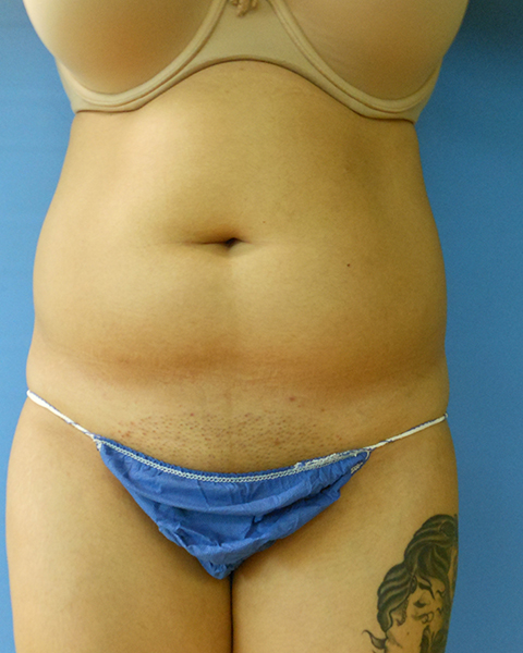 Abdomen Before & After Gallery - Patient 51821686 - Image 1