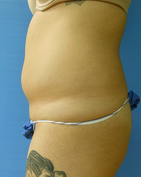 Abdomen Before & After Gallery - Patient 51821686 - Image 3