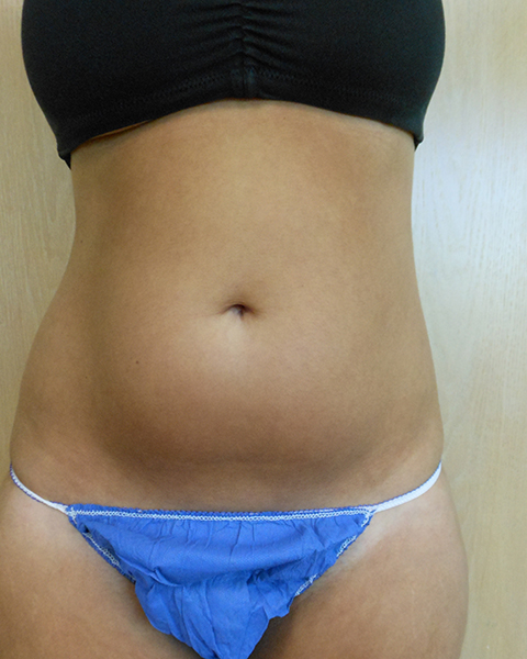 Abdomen Before & After Gallery - Patient 51821749 - Image 1