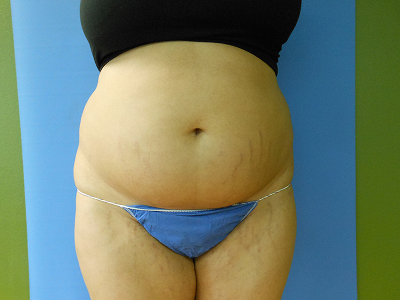 Abdomen Before & After Gallery - Patient 51821750 - Image 1