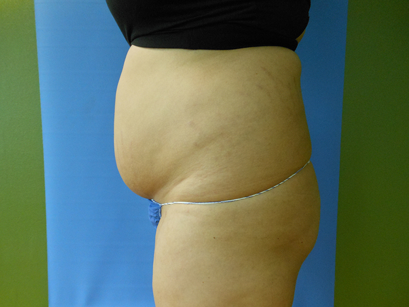 Abdomen Before & After Gallery - Patient 51821750 - Image 3