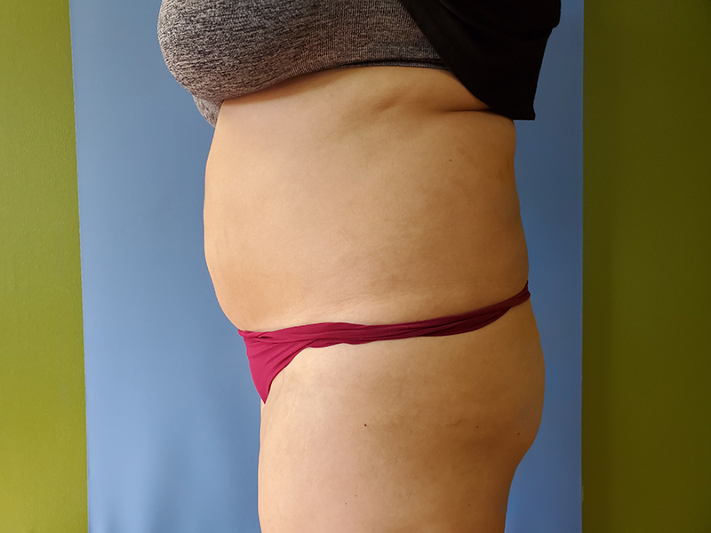 Abdomen Before & After Gallery - Patient 51821750 - Image 4