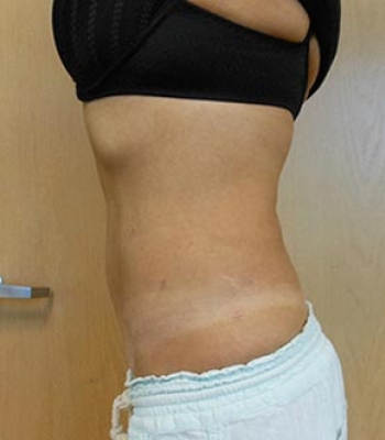 Abdomen Before & After Gallery - Patient 51821752 - Image 2