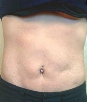 Abdomen Before & After Gallery - Patient 51821754 - Image 2