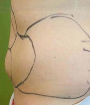 Abdomen Before & After Gallery - Patient 51821755 - Image 3