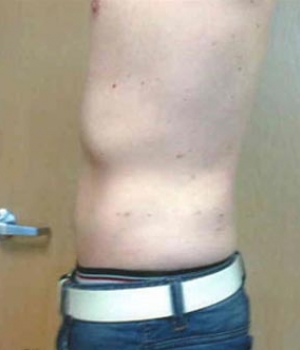 Abdomen Before & After Gallery - Patient 51821755 - Image 4
