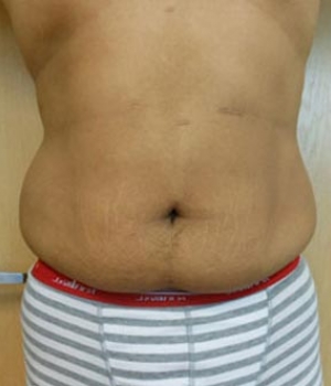 Abdomen Before & After Gallery - Patient 51821756 - Image 1